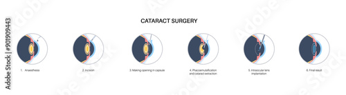 Cataract surgery poster