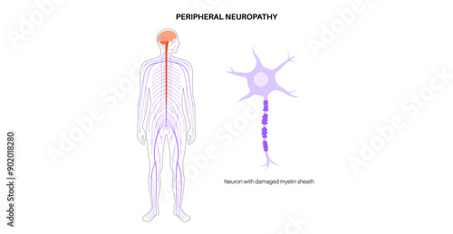 Peripheral neuropathy medical poster