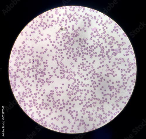 Anisocytosis anisochromia with both microcytic hypochromic and macrocytic hypochromic RBC with rouleaux formation, Dimorphic anemia