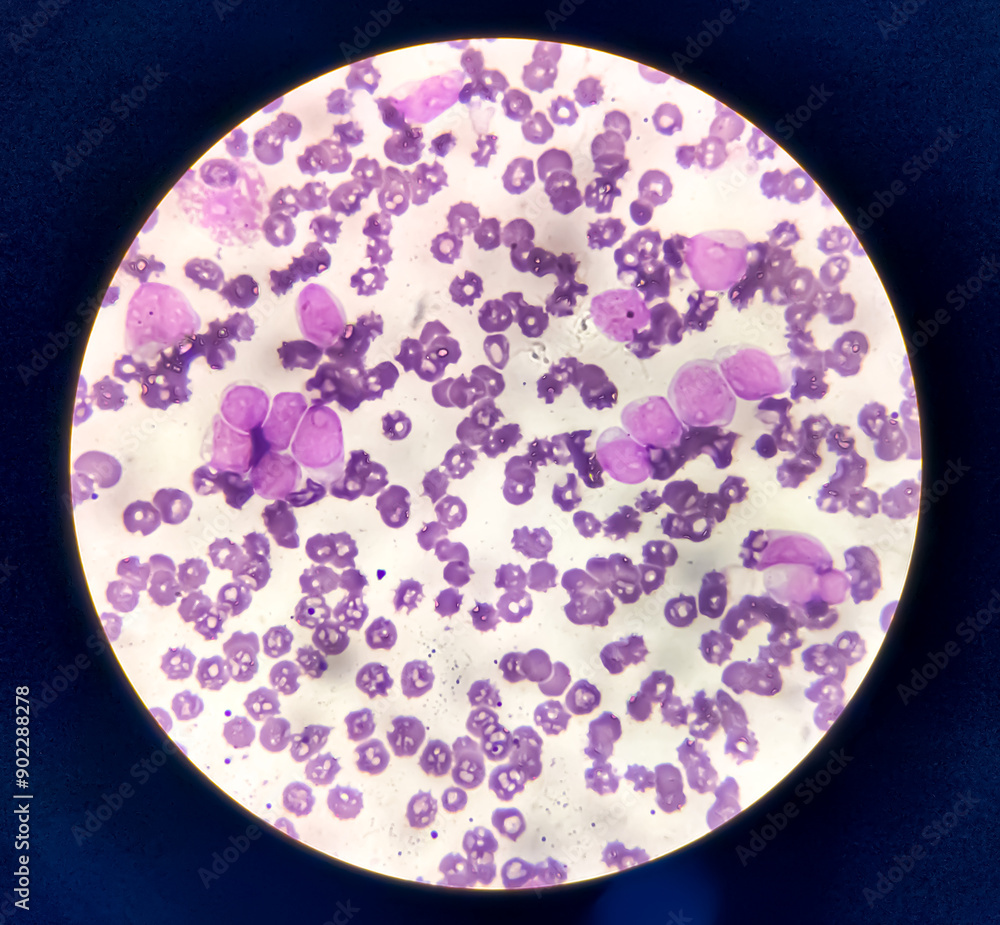 Acute leukemia, ALL(Acute lymphoblastic leukemia), peripheral blood smear, Under 100x light microscope to diagnosis of Acute leukemia. Acute leukemia, ALL(Acute lymphoblastic leukemia), peripheral blood smear, Under 100x light microscope to diagnosis of Acute leukemia.
