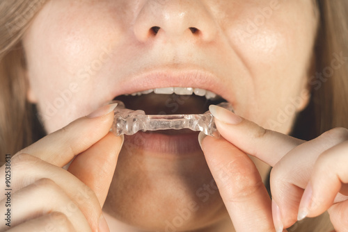 Woman puts dental splint guard in her mouth. TMJ splint disorder treatment..Occlusal splint. Prevent bruxism..Mouth guard for TMJ. Teeth protection. Pain in jaw. Teeth grinding.