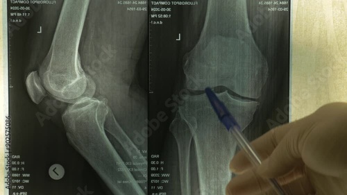 A doctor shows a problem in a patient's knee joint on an x-ray. X-rays show osteoarthritis in a patient's knee joint.
