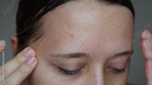 Young caucasian woman with greasy skin on her forehead touching the oily face with her hand on a dark grey background. Cosmetology and beauty concept. Oily skin, shine on the face, pimples, acne