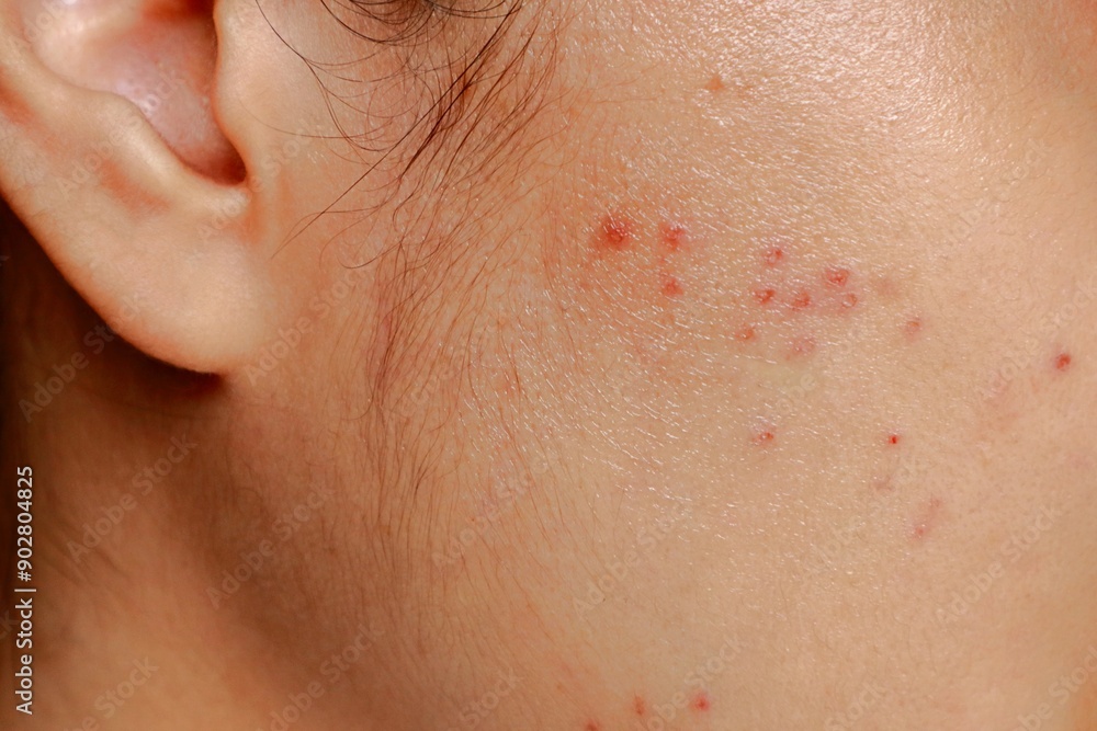 Asian woman facial skin with red spots and swelling after acne laser treatment and popping by dermatologist to removed acne after 1 day. Asian woman facial skin with red spots and swelling after acne laser treatment and popping by dermatologist to removed acne after 1 day.