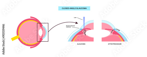 Iridectomy medical poster