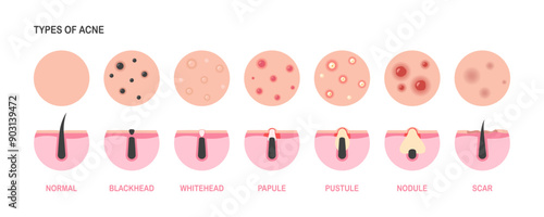 Stages of acne development. Acne of types and skin disease: skin pimples, face comedones, blackheads.