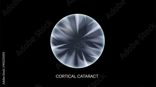 Cataract eye disease