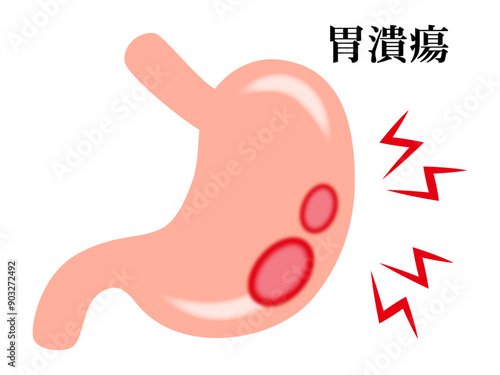 胃潰瘍の胃腸のイラスト素材