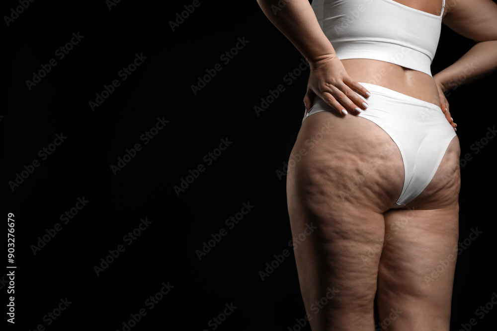 Fototapeta premium Woman with cellulite on black background, closeup. Space for text