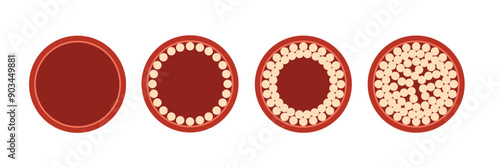 Atherosclerosis thrombus vessel cholesterol level artery. Plaque heart thrombus cardiovascular system blood vector disease illustration