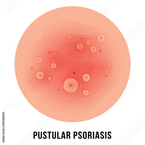 Detailed illustration of skin condition effects at pustular psoriasis