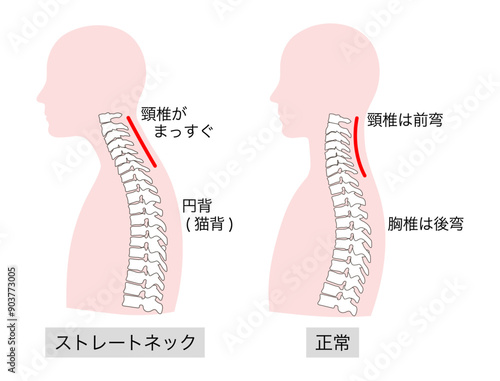 正常とストレートネックの上半身の説明比較イラスト
