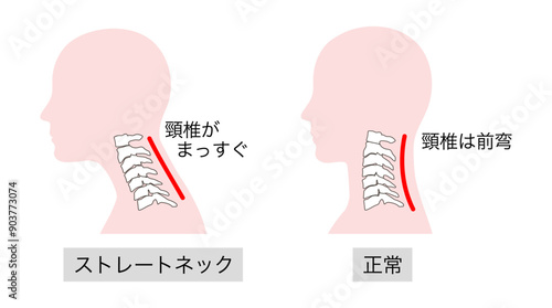 ストレートネックと正常な頸椎の比較イラスト