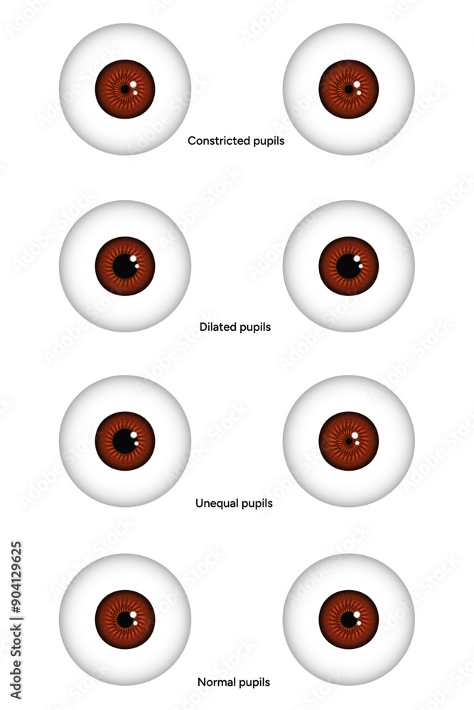 Unequal, Constricted, Dilated and normal pupils eye diseases ophthalmology Unequal, Constricted, Dilated and normal pupils eye diseases ophthalmology