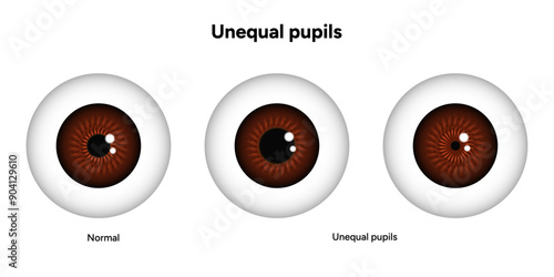 Unequal pupils eye diseases ophthalmology