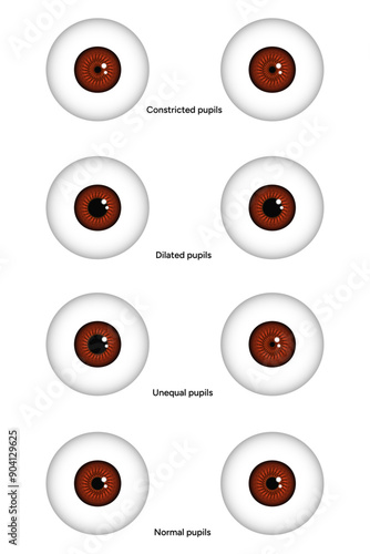 Unequal, Constricted, Dilated and normal pupils eye diseases ophthalmology