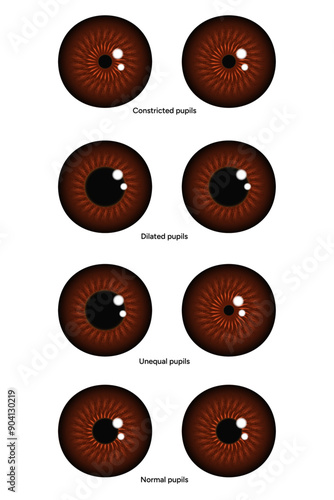 Unequal, Constricted, Dilated and normal pupils eye diseases ophthalmology