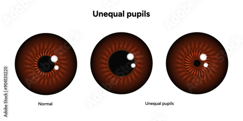 Unequal pupils eye diseases ophthalmology
