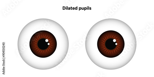 Dilated pupils eye diseases ophthalmology