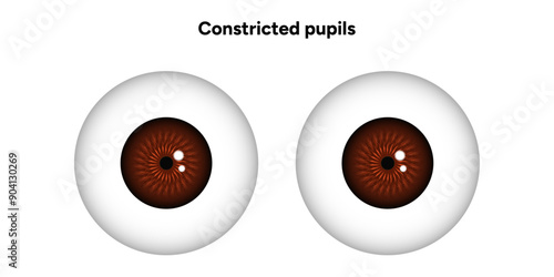 Constricted pupils eye diseases ophthalmology