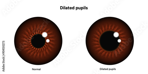Dilated pupils eye diseases ophthalmology