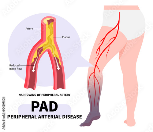 Peripheral artery disease of clot leg veins by fatty or injury that cause pain and high blood pressure