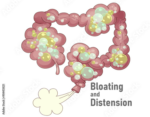 Bloating and Distension. Healthcare illustration. Cartoon illustration. Vector illustration.