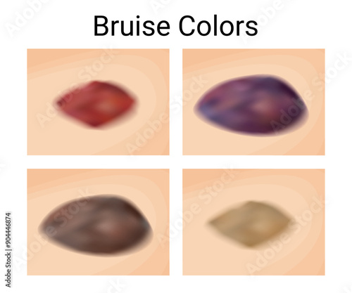 Healing Stages of Bruises and Hematomas