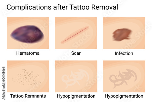 Skin Complications Post Tattoo Removal. Vector illustration design.