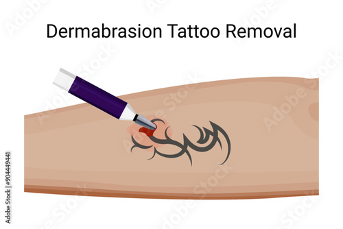 Effective Dermabrasion Tattoo Removal Procedure