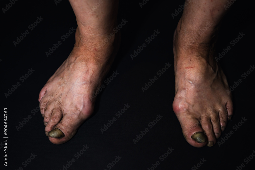 Fototapeta premium A close-up toenail suffering from onycholysis, characterized by its separation from the nail bed.