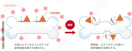 女性ホルモンのエストロゲンと骨粗鬆症の関係