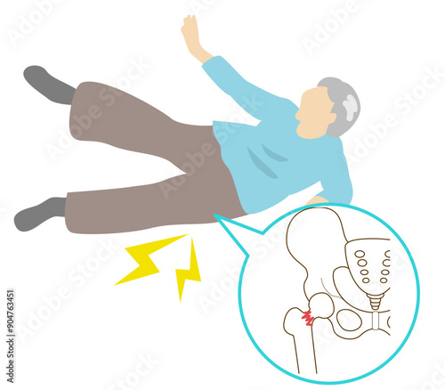 骨粗鬆症による高齢者の転倒骨折の好発部位。足の付け根の骨折