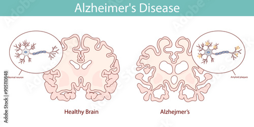 Healthy brain and brain with Alzheimer's disease. Hand drawn illustration.