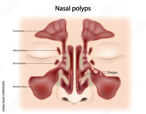 Nasal polyps (NP) Noncancerous growths on the lining of the nose or sinuses. Otorhinolaryngology