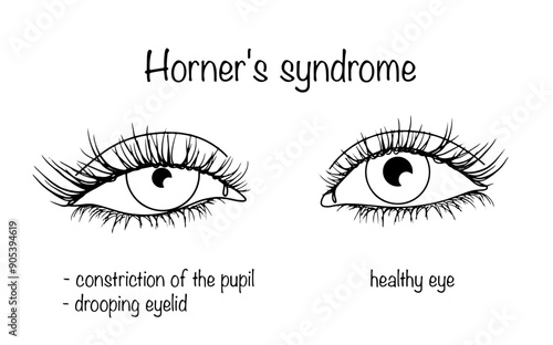 Horner's syndrome