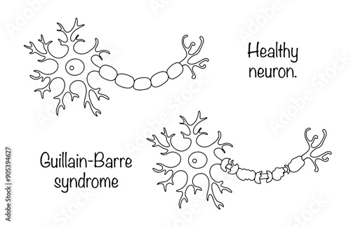 Guillain-Barre syndrome