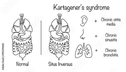Kartagener's syndrome