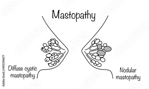 Mastopathy