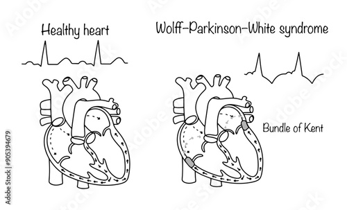 WPW syndrome