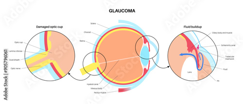 Glaucoma eye disease