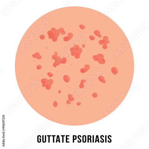 Guttate psoriasis vector illustration isolated on white background