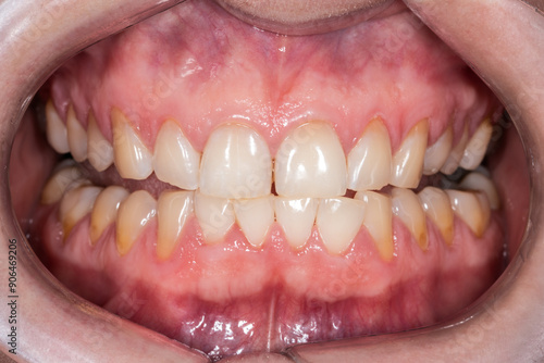 Wedge-shaped defects in human permanent teeth. Gum recession.