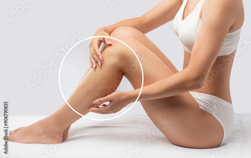 Slender, beautiful legs of a woman. Hair removal procedure on a woman’s body. Medical inspection and treatment of Telangiectasia. Phlebeurysm. photo