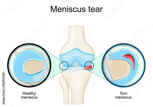 Meniscal tear. Knee anatomy. Close-up of Torn meniscus
