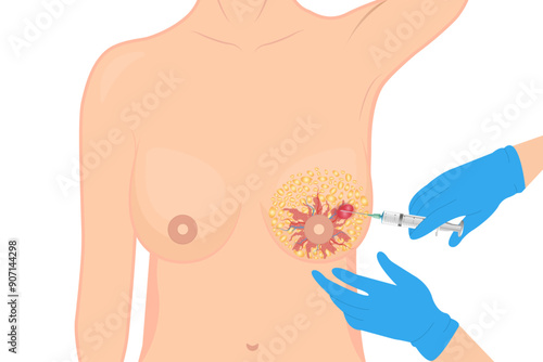 Breast cancer diagnostic biopsy to obtain a sample by an experienced physician in a medical clinic