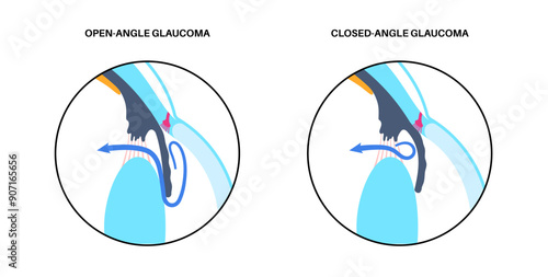 Glaucoma eye disease