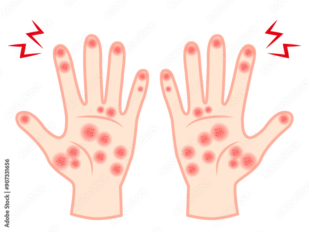 Fototapeta premium 手荒れと手湿疹で赤くなった両手のイラスト素材