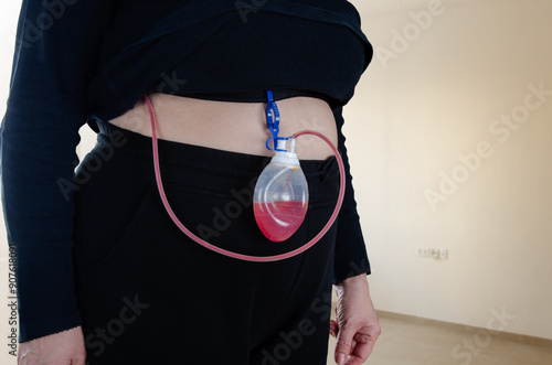 Understanding Post-Surgical Drains: Woman’s Experience with Drainage System After Lumpectomy