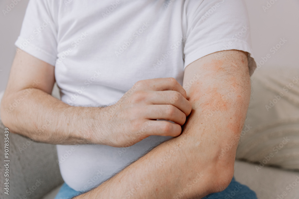 Close up shot of senior fat man scratching forearm sitting on living room at home. Allergy symptom. Copy space Close up shot of senior fat man scratching forearm sitting on living room at home. Allergy symptom. Copy space